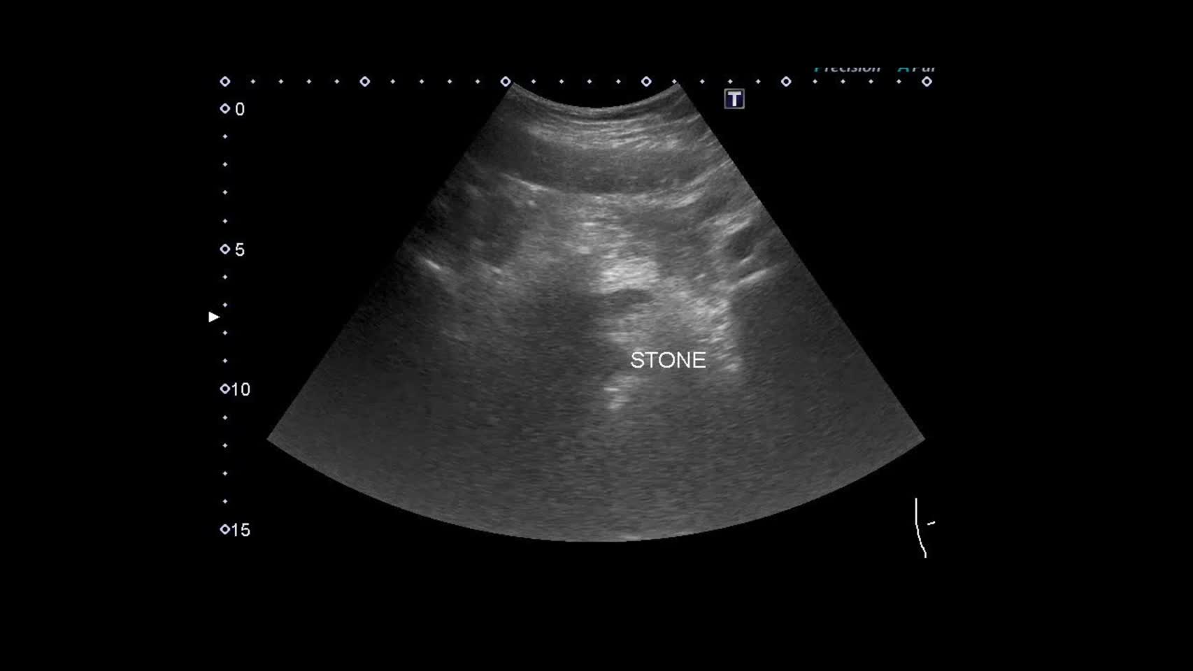 動画02 膀胱尿管移行部（図2に対応）